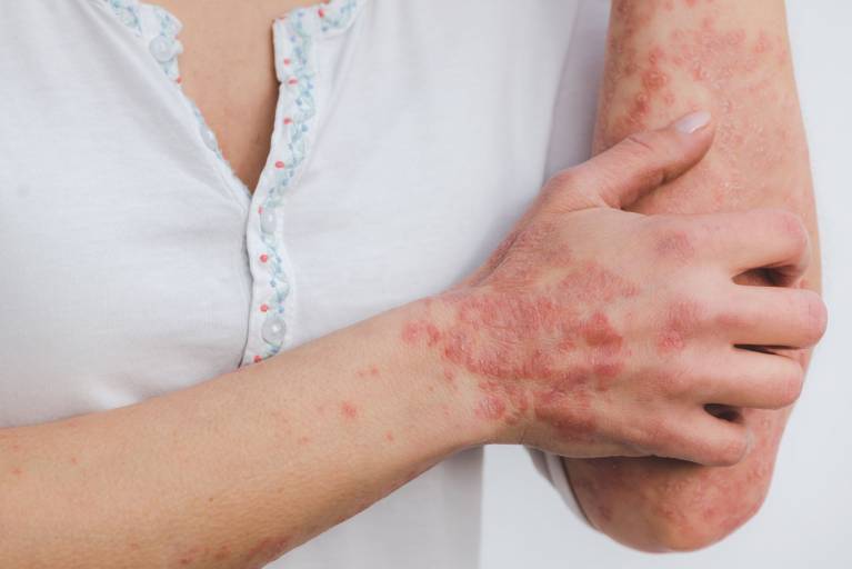 5 věcí, které byste měli vědět o lupénce 5 věcí, které byste měli vědět o lupénce